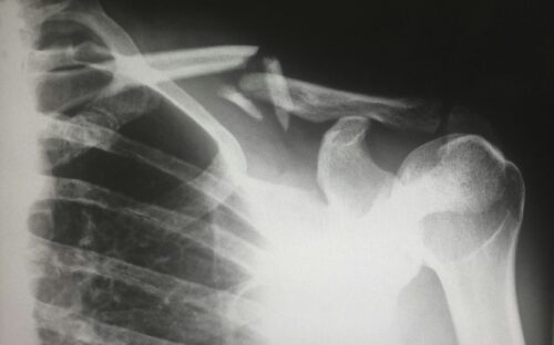 X-ray image showing a bone fracture of the collarbone (clavicle) with a displaced break; the bone ends are misaligned and separated, surrounded by ribs and part of the shoulder joint.